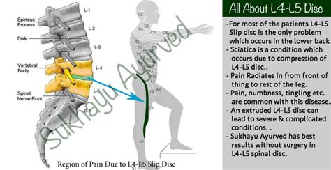 Where Is L4l5 Located On Spine