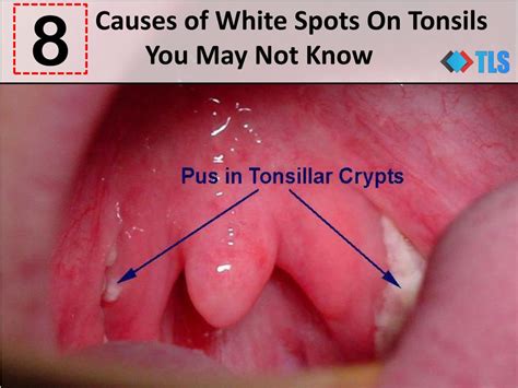 Whitish On Tonsils