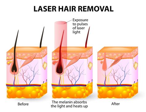 Will Laser Hair Removal Work