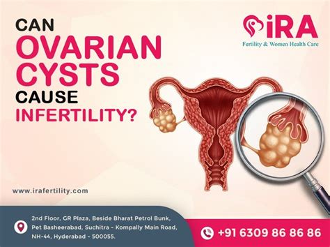 Will Ovarian Cysts Cause Infertility
