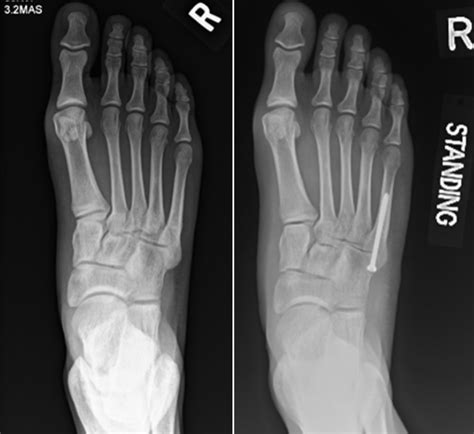 X Ray Of Fractured Toe